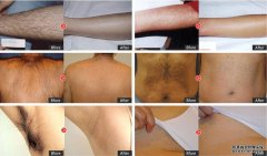 OPT脫毛儀器的效果有多好,不試你不會知道！